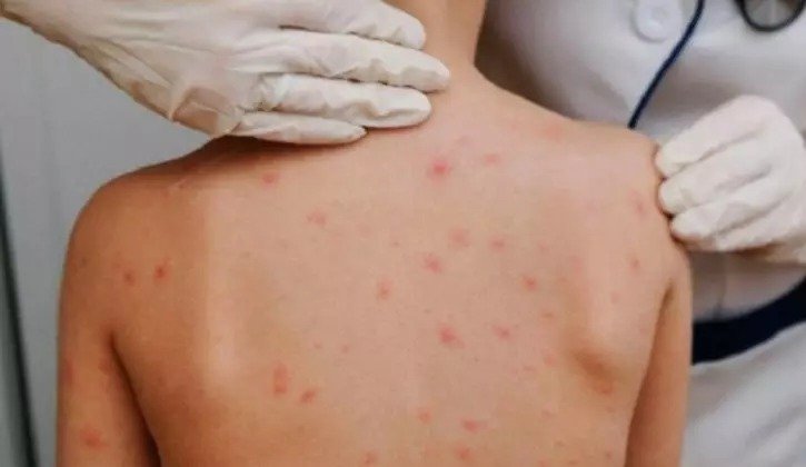 Balneário Camboriú declara surto de sarna e faz inspeção em escolas