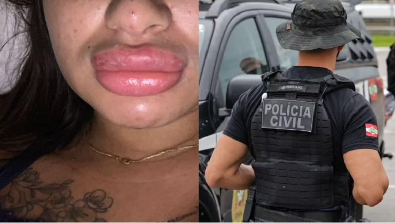 policia-abre-investigacao-apos-mulheres-denunciarem-deformacoes-causadas-por-falsa-biomedica