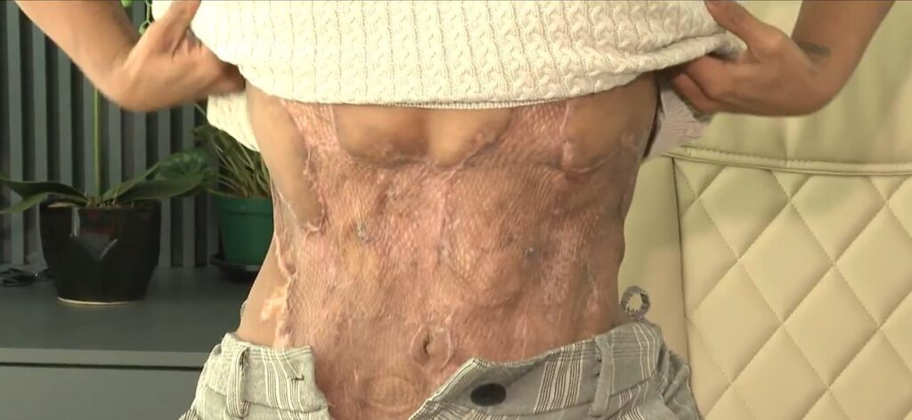 Médico é condenado a cinco anos de prisão por deformar paciente em cirurgia plástica em Florianópolis